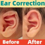 Infant Stick Out Ear correction, Protruding Ear Corrector