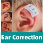 Prominent Ear Corrector Clip, Cup Ear Deformity Correction