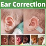 Lop Ear Corrector Tape, Cryptotia Deformity Correction