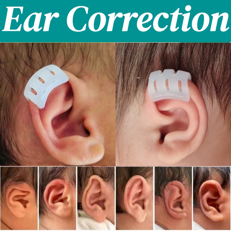 Non-surgical-infant-ear-correction-using-baby-ears-sticker-system