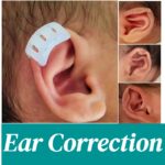 Non-surgical-ear-molding-process-on-infant-using-newborn-ear-shape-corrector