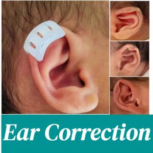 Non-surgical-ear-molding-process-on-infant-using-newborn-ear-shape-corrector