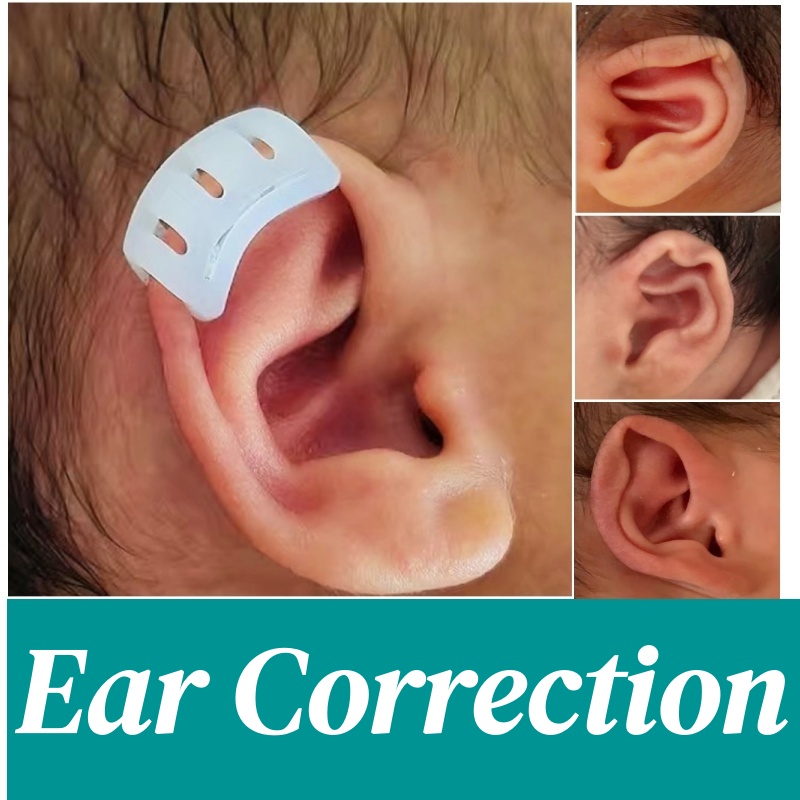 Non-surgical-ear-molding-process-using-ear-corrector-clip-72-hour-window