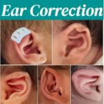 Non-surgical-baby-ear-shape-correction-process-on-newborn-infant