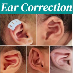 Non-surgical-baby-ear-shape-correction-process-on-newborn-infant