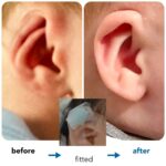 Cryptotia Ear Deformity Repair Treatment Non Surgical