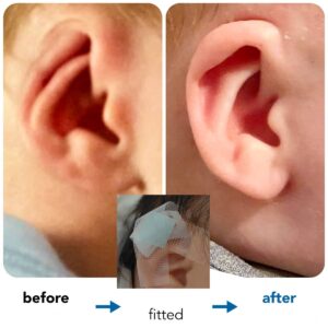 Cryptotia Ear Deformity Repair Treatment Non Surgical