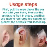 Cryptotia Ear Deformity Treatment Without Surgery, Fixing Repair Cryptotia Non Surgical 1