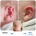 Fixing Stahls Bar Ear Deformity 1