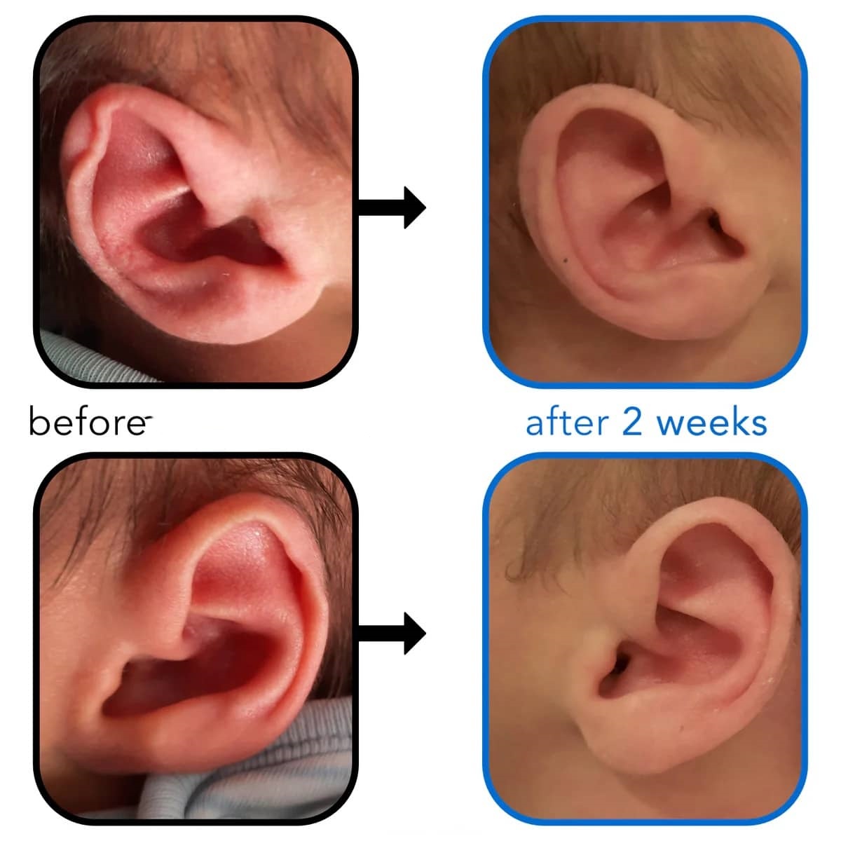 Ear Rim Rolled Constricted Ear, Helical Rim Kink Correction
