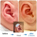 constricted ear in adults