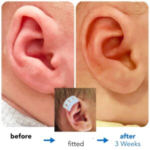 constricted ear in adults