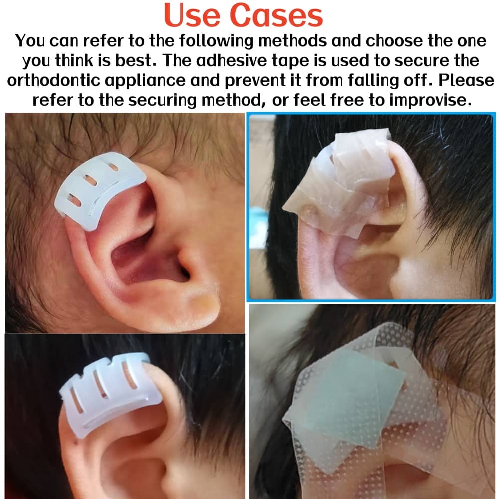 https://www.babyearfix.com/ear-molding-infant-corrector/constricted-ear-helical-rim-kink-correction/