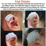 constricted ear newborn