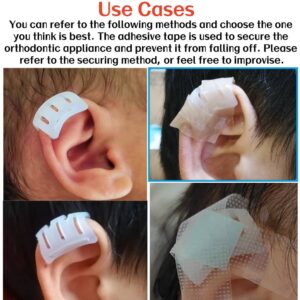 constricted ear newborn