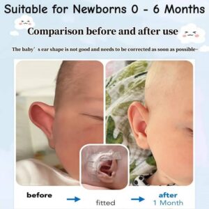 correcting ears that stick out 2