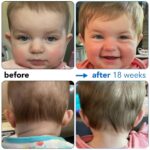 protruding ears treatment 1