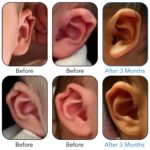 rim kink ear