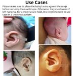 sticking out ears treatment