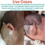 Fixing Conchal Crus Deformity Conchal Crus Ear Correction Without Surgery 11