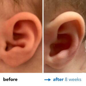 Fixing Conchal Crus Deformity Conchal Crus Ear Correction Without Surgery 8